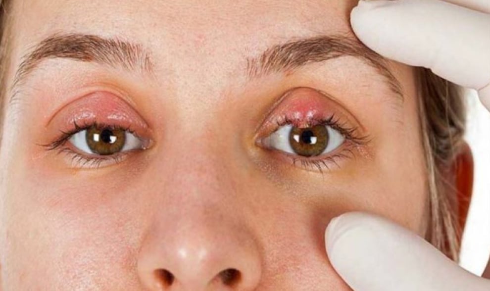 5 mẹo ngăn ngừa lẹo mắt khi dùng kính áp tròng